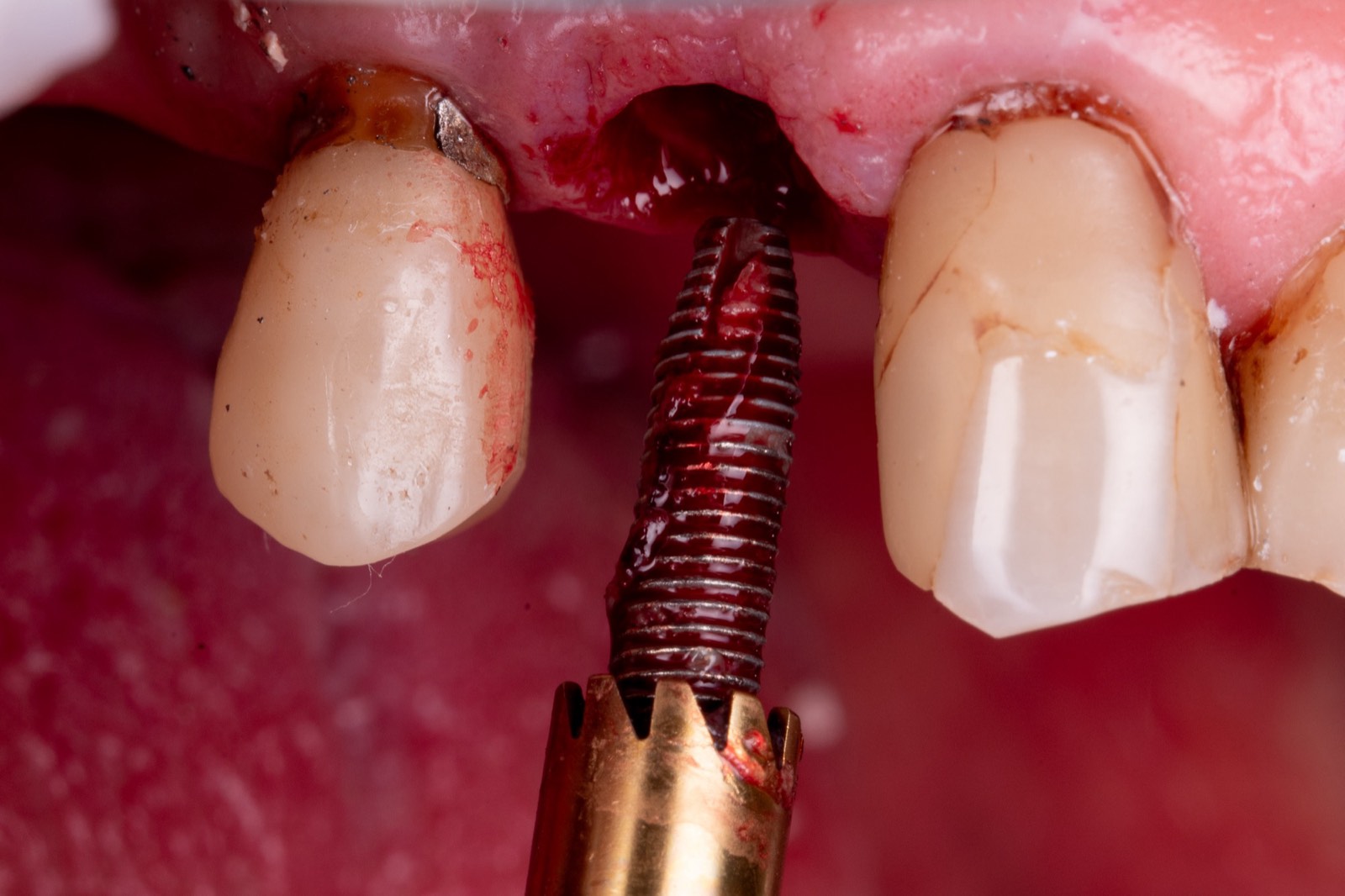 Implant removal