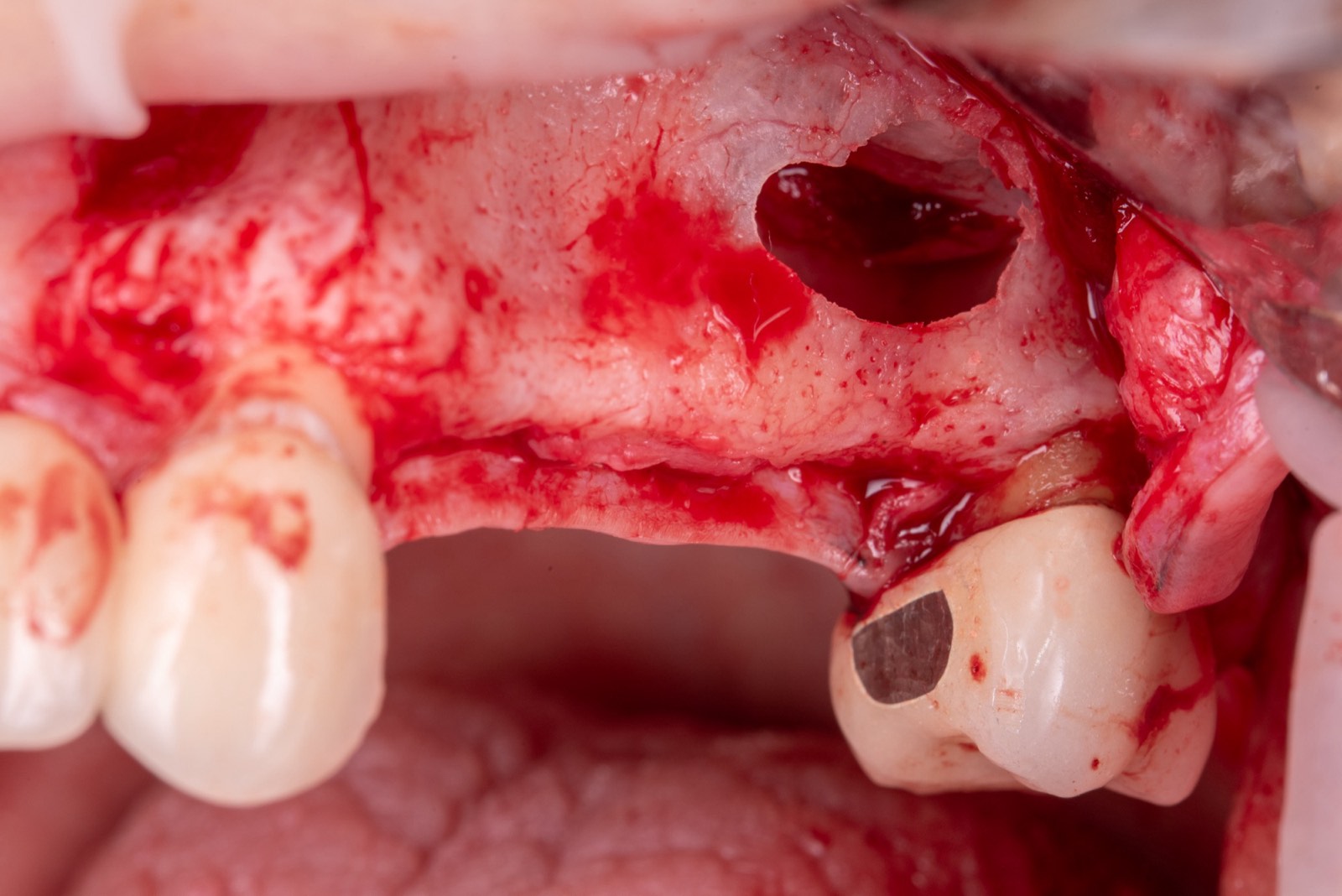 Crestal and lateral sinus augmentation