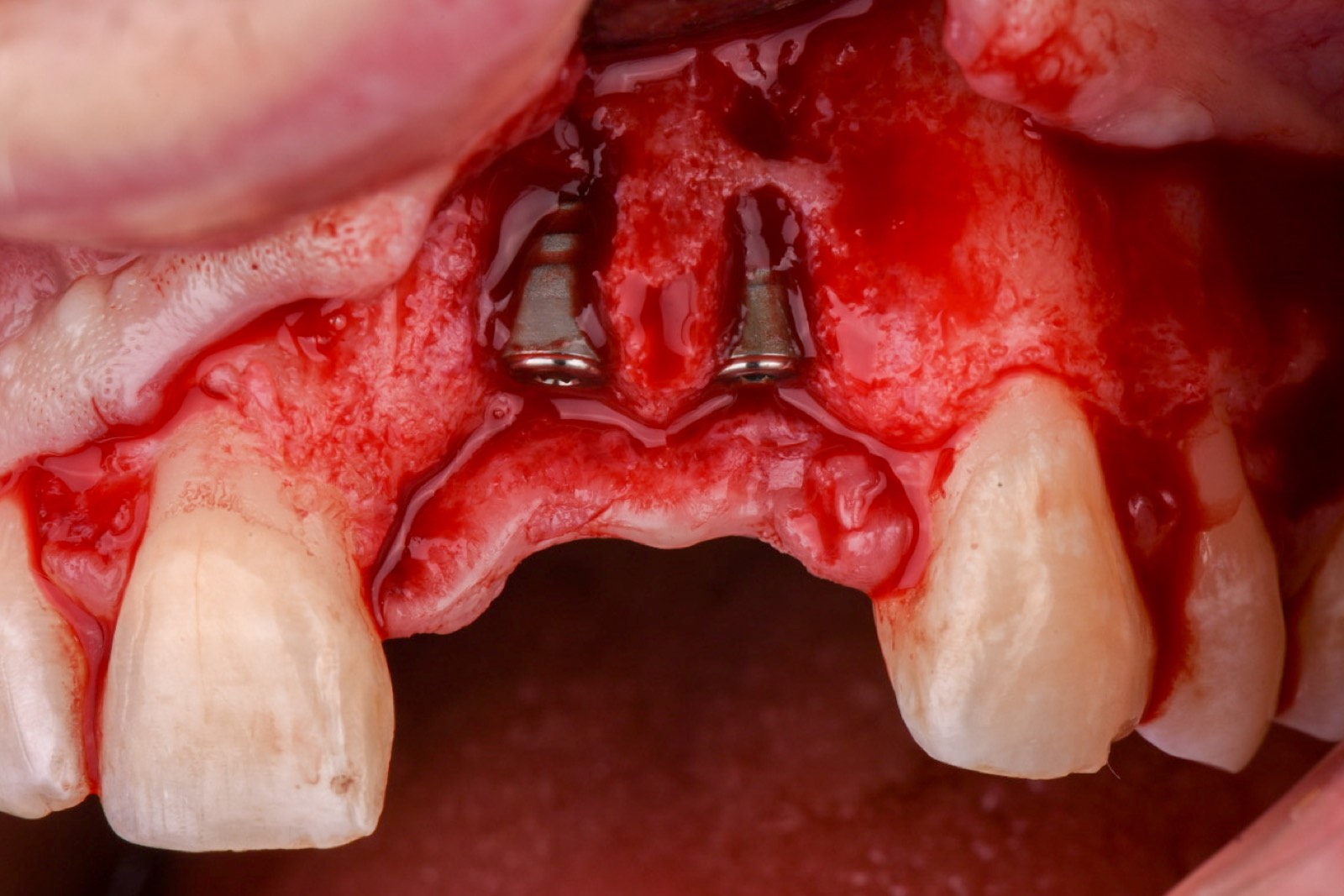 Implant placement with simultaneous GBR