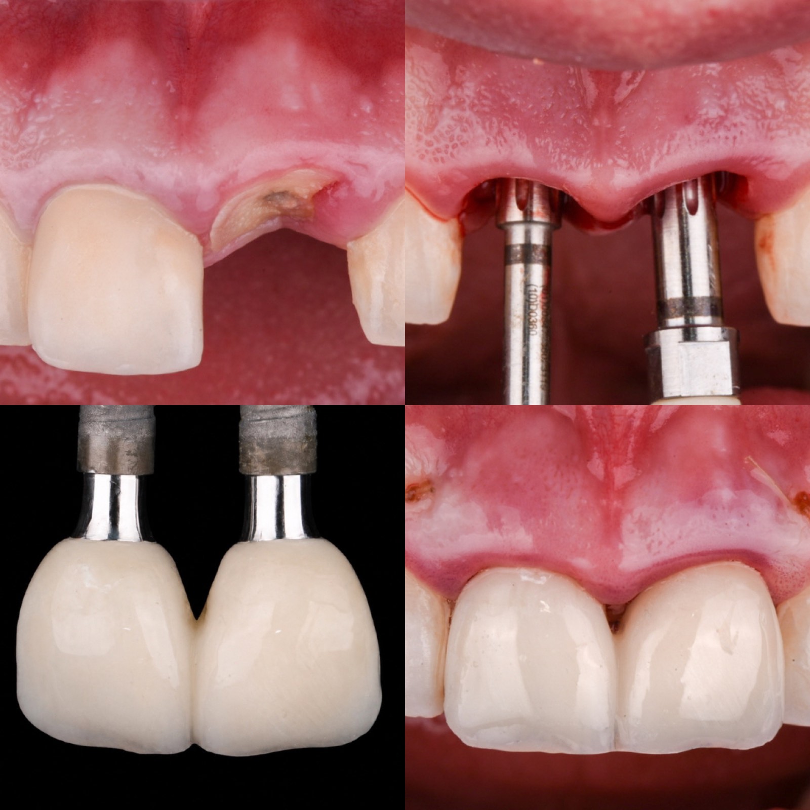 Clinicians at a hands-on immediate-implant lab