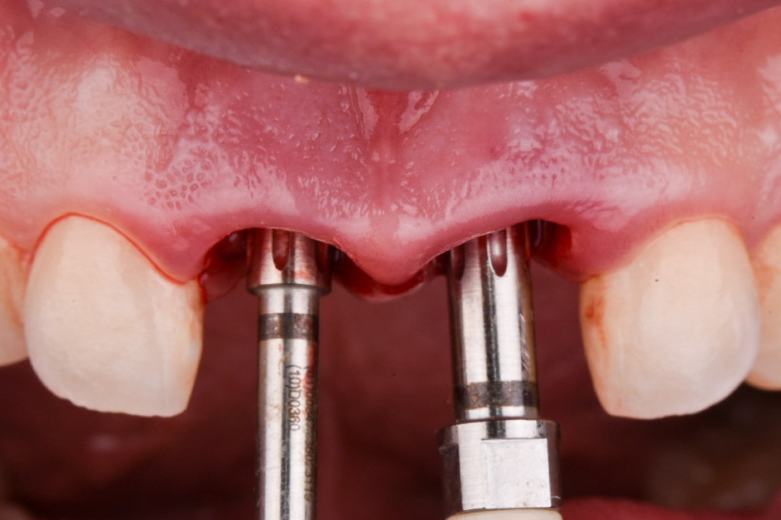 Immediate implant placement