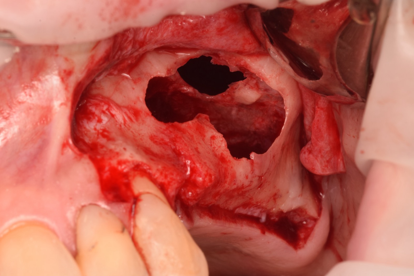 Avoiding and treating bone grafting complications