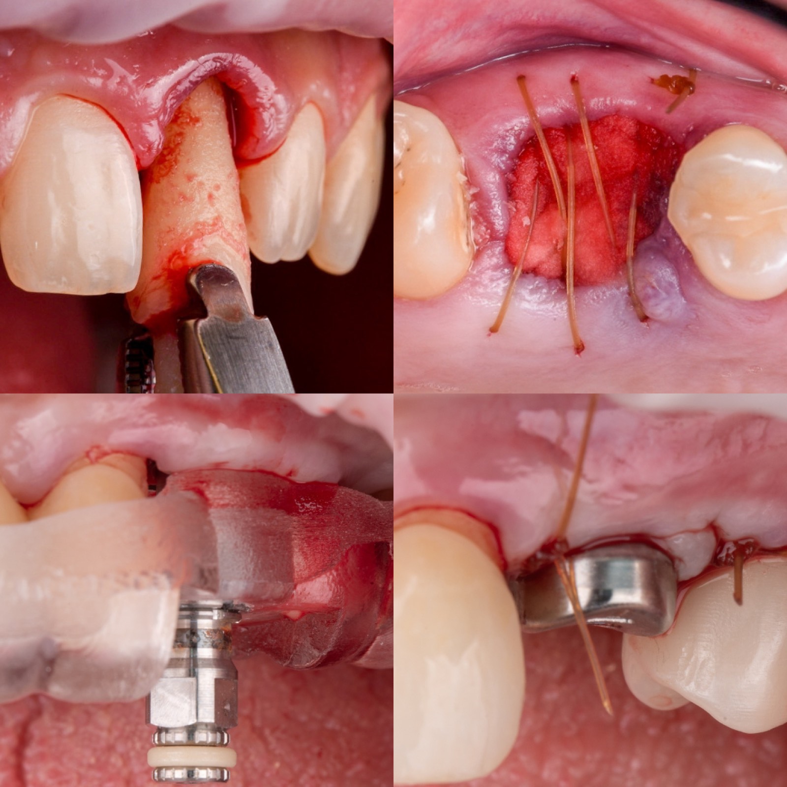 Clinicians at a hands-on single-implant surgical lab