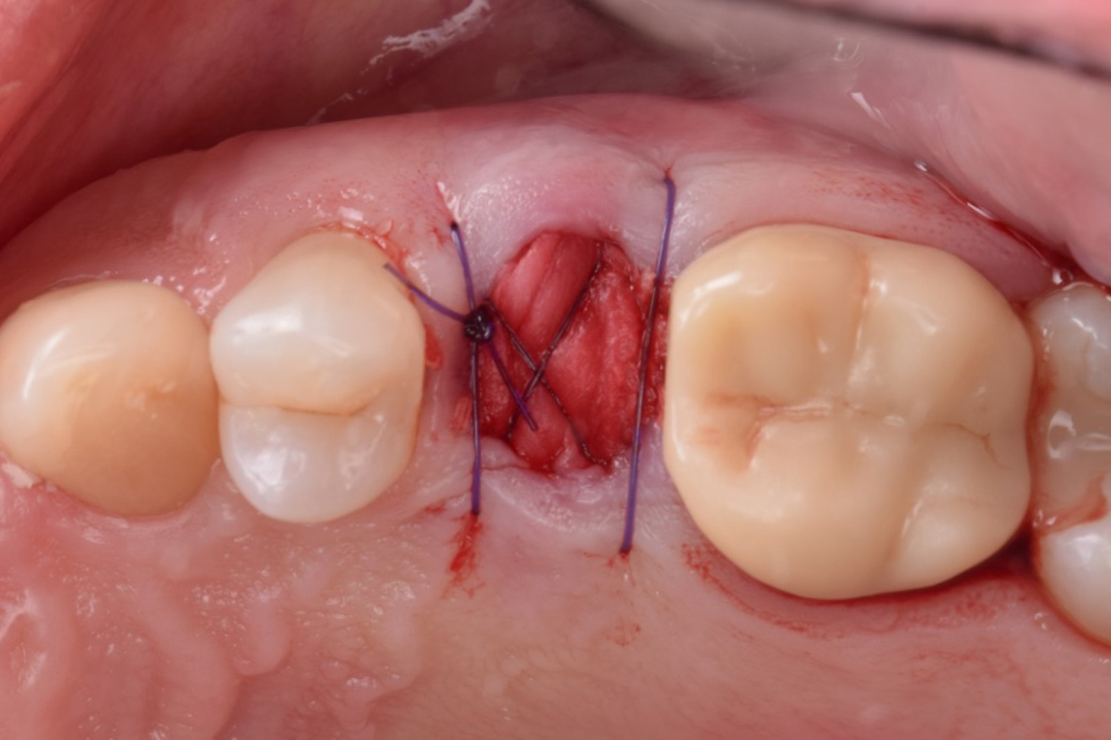 Atraumatic extraction and socket preservation