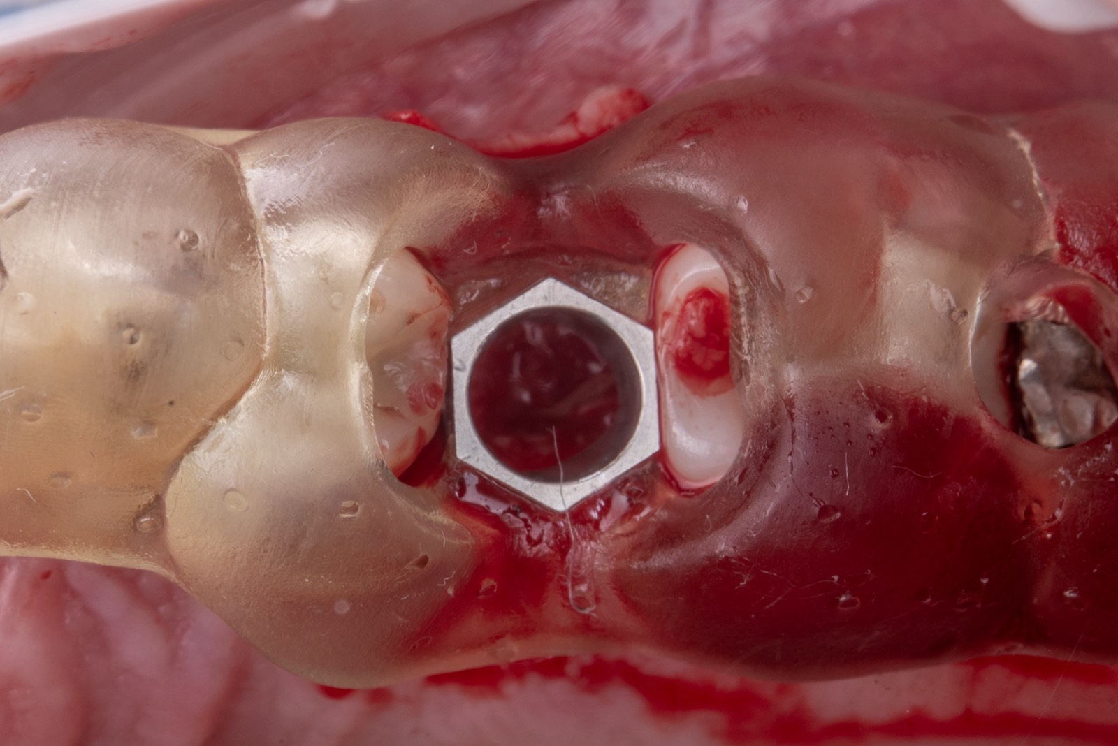 Single implant placement